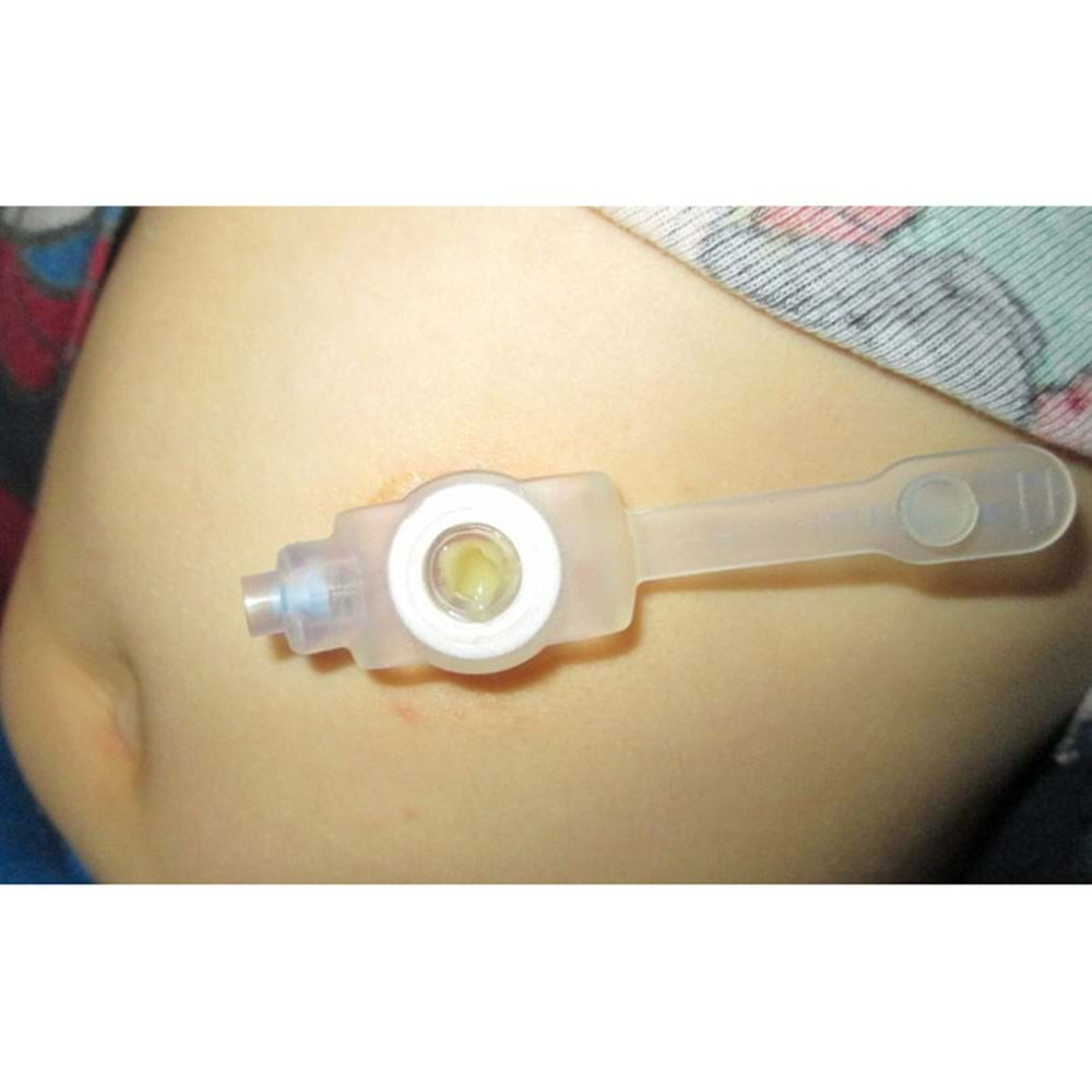 Gastrostomi Buton Kiti Kangaroo NutriPort 720200 No: 20 6.7mmx2.0cm