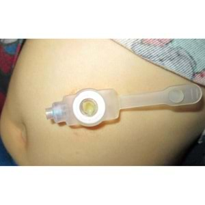 Gastrostomi Buton Kiti Kangaroo NutriPort 720080 No: 20 6.7mmx0.8cm